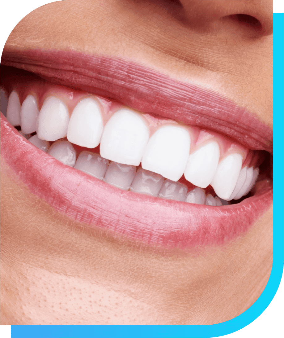 Dental Gum Graft in California | Smile Select Dental