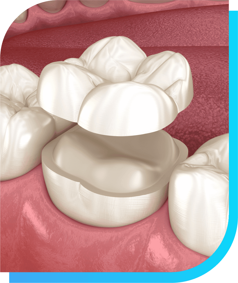 What are Dental Inlays and Onlays | Smile Select Dental