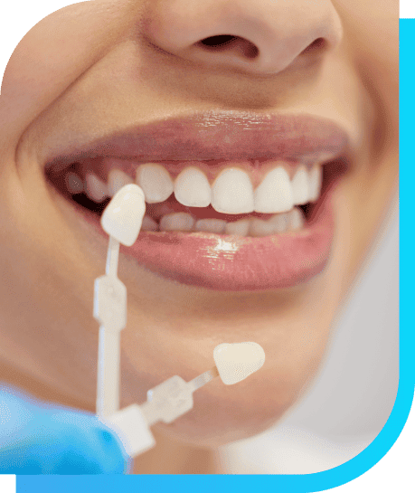 What are Dental Veneers | Smile Select Dental