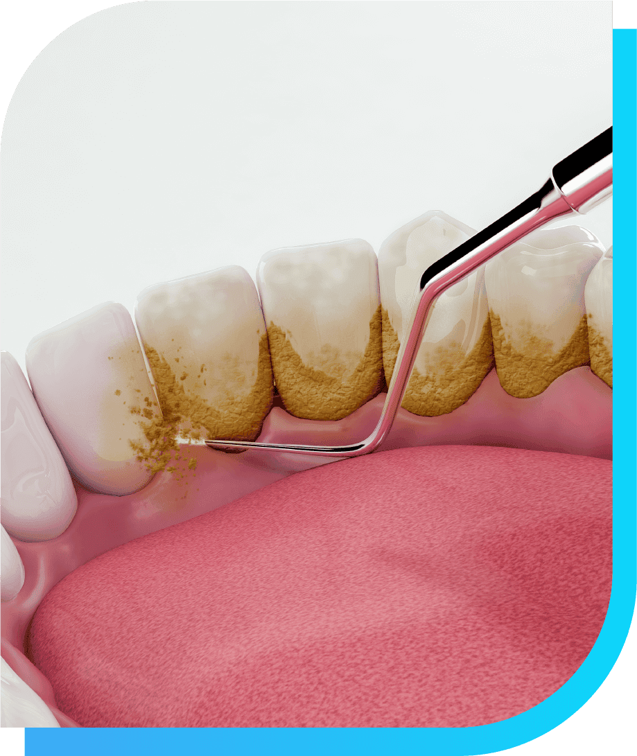 What is Dental Hygiene | Smile Select Dental