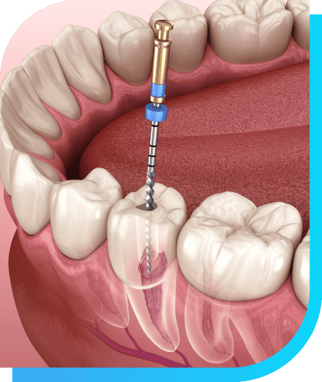 Endodontics | Smile Select dental