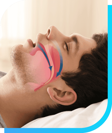 Sleep Apnea | Smile Select Dental